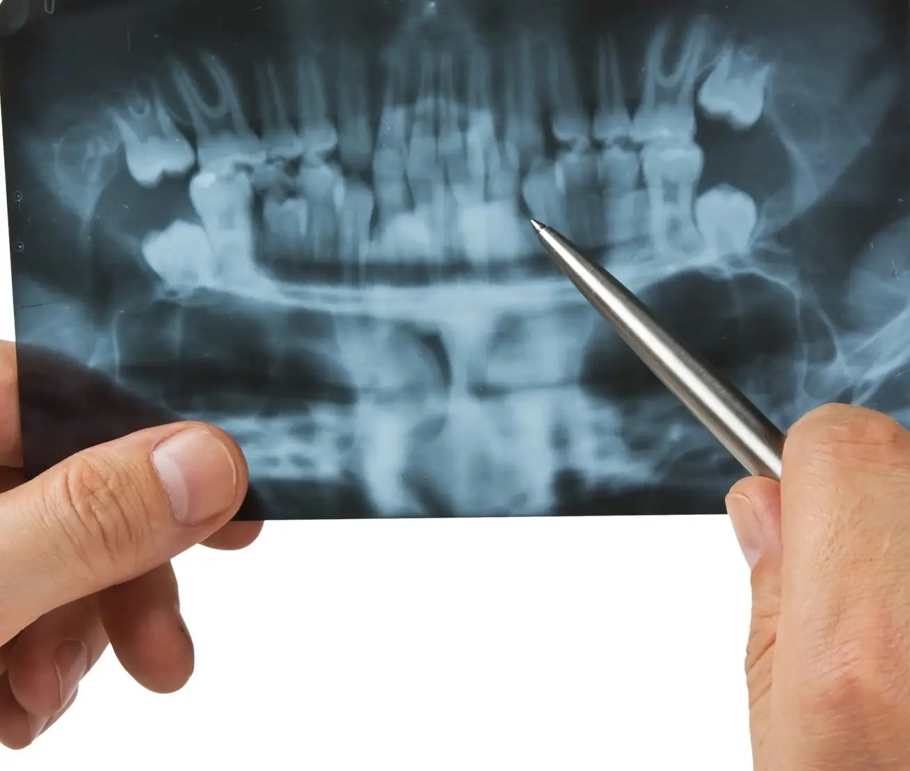 X-rays of teeth