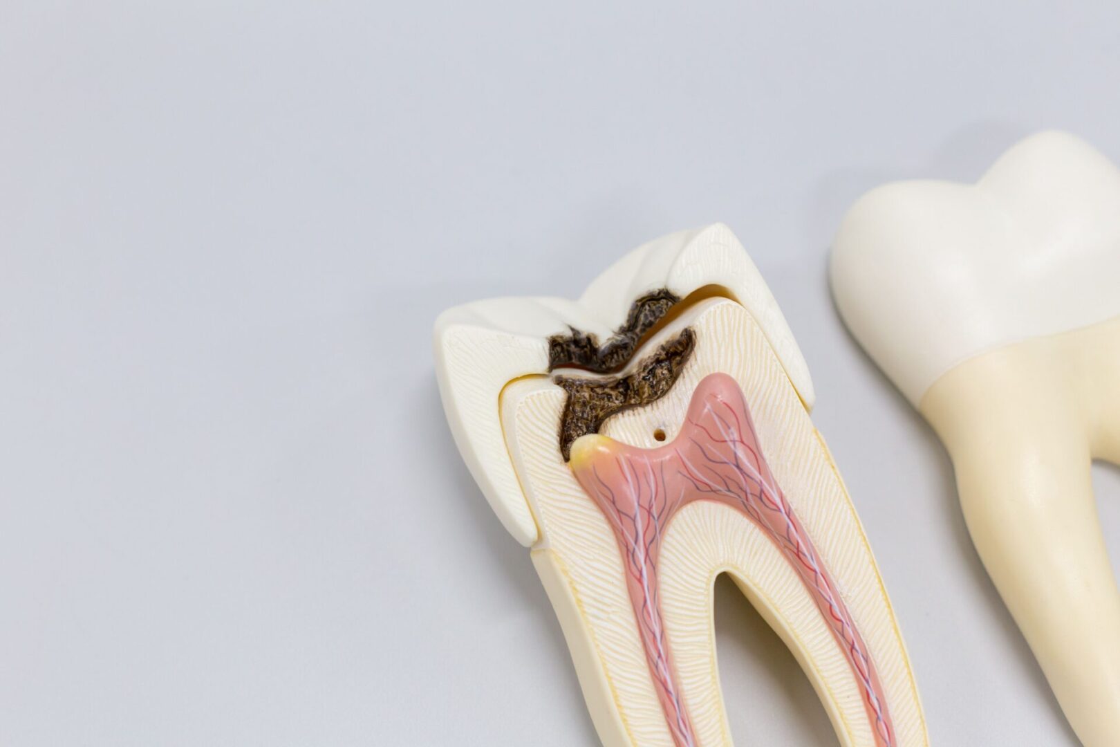 A tooth with root and caries on it