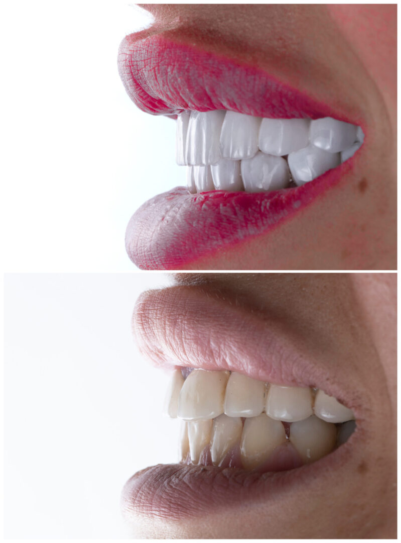 Teeth whitening process before and after