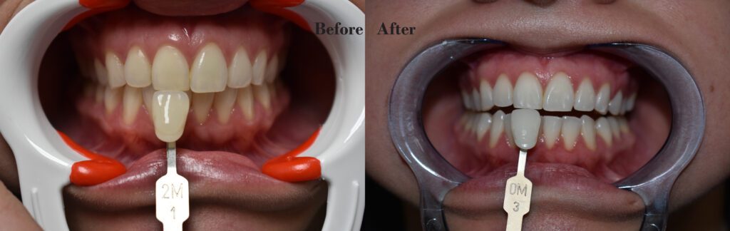 teeth bleaching example before and after