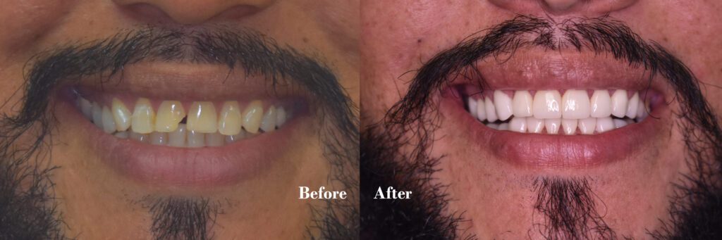 dental crowns example before and after