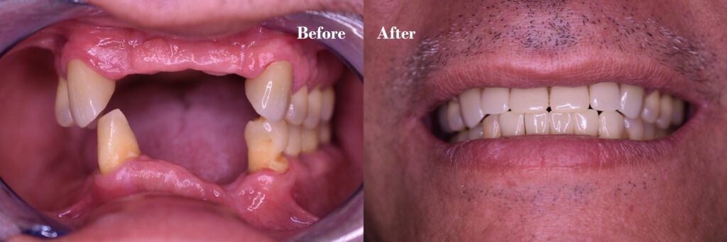 dental implants and fake teeth