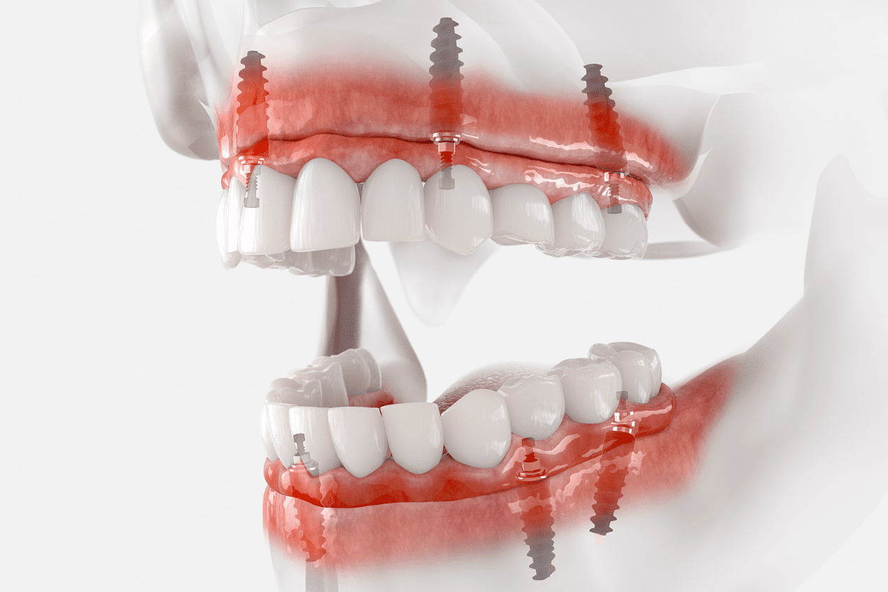 Full Mouth implant mockup