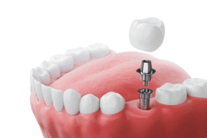 Single-tooth implant graphic