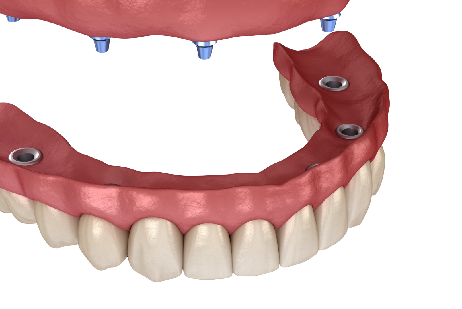 All-on-4 dental implants mockup