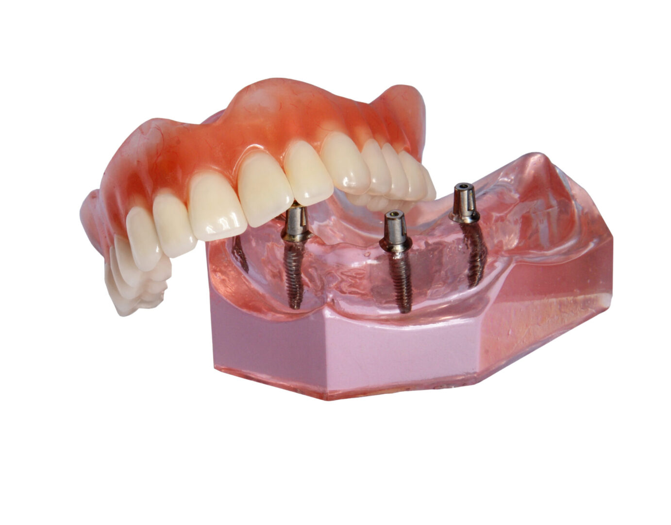 Denture,Lies,On,Model,Of,Top,Tooth,Jaw,With,Implants